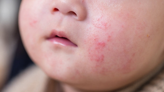 A Gentle Solution for Baby Cheek Rashes and Redness
