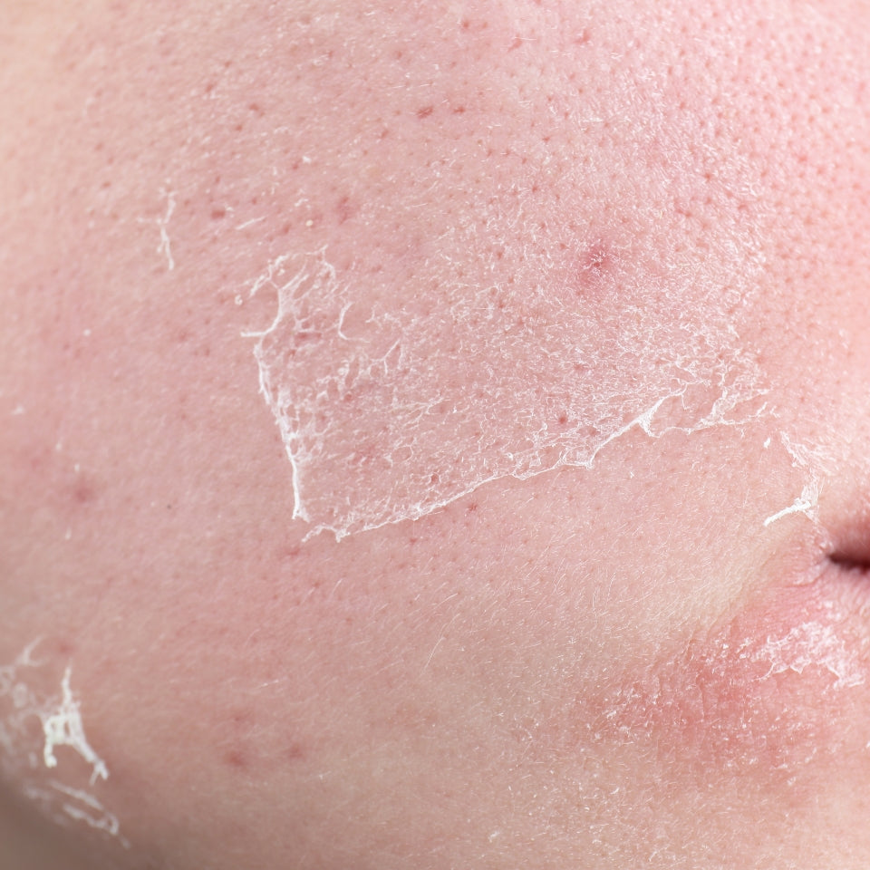 Sensitive skin